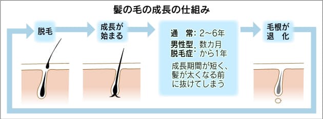 薄毛 自分に合った対応策知ろう 皮膚科学会が診療の指針 Nikkei Style 薄毛 自分に合った対応策知ろう 皮膚科学会が診療の指針 Nikkei Style