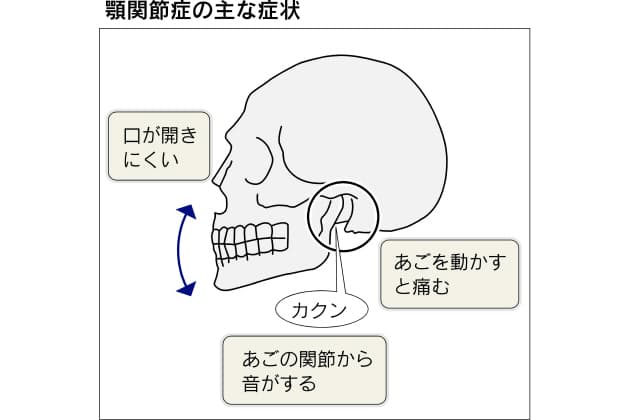 あごのトレーニングで上下の歯くっつく癖を改善 顎関節症 口が開きにくい あごが Nikkei Style