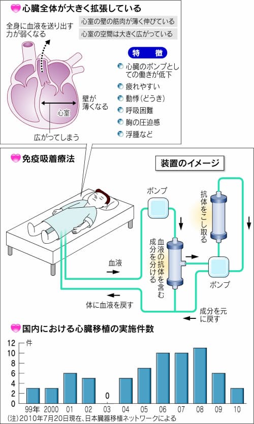 拡張型心筋症 心移植せず治療 臨床研究に注目 Nikkei Style 拡張型心筋症 心移植せず治療 臨床研究に注目 Nikkei Style