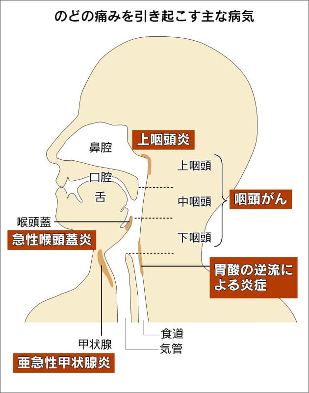 急性喉頭蓋炎 咽頭がんの可能性も のどの痛み 本当に風邪か Nikkei Style