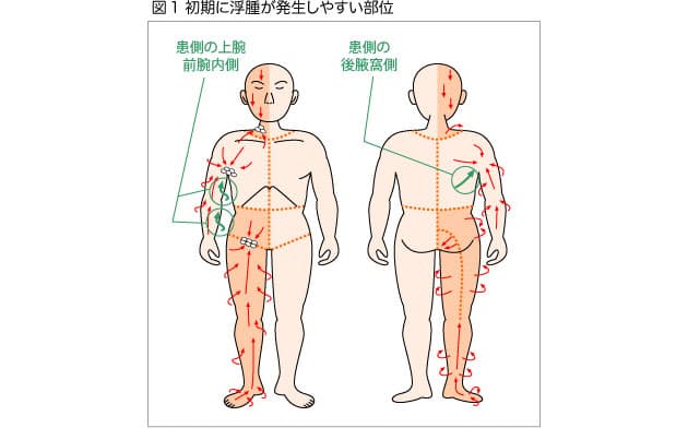 乳がんのリンパ浮腫の予防と進行を防ぐためのポイント 上 Nikkei Style 乳がんのリンパ浮腫の予防と進行を防ぐためのポイント 上 Nikkei Style