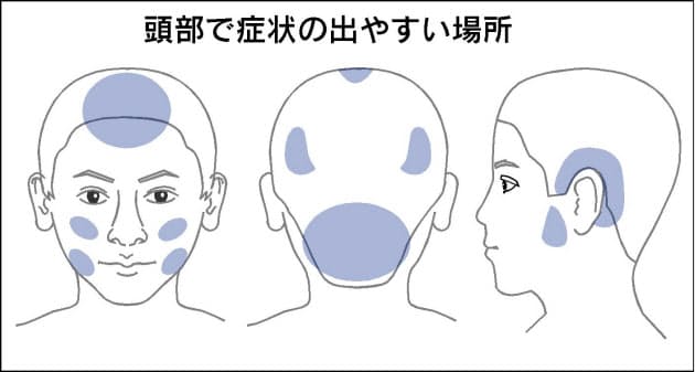 頭 腹部の水虫 初期治療でまん延防止 日経bizgate 頭 腹部の水虫 初期治療でまん延防止 日経bizgate
