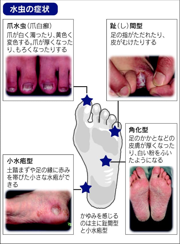 足 の 指 の 間 かゆい 水虫 では ない