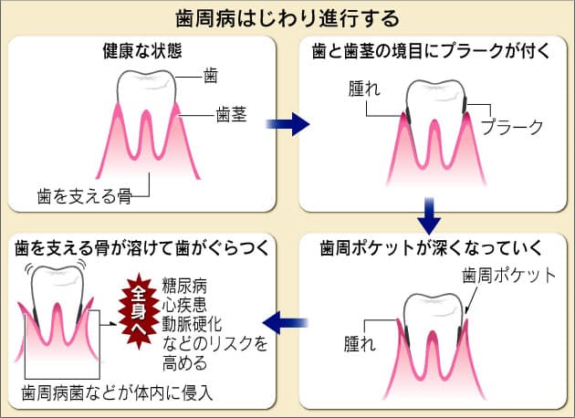 歯周病 心疾患 糖尿病を悪化 Nikkei Style 歯周病 心疾患 糖尿病を悪化 Nikkei Style