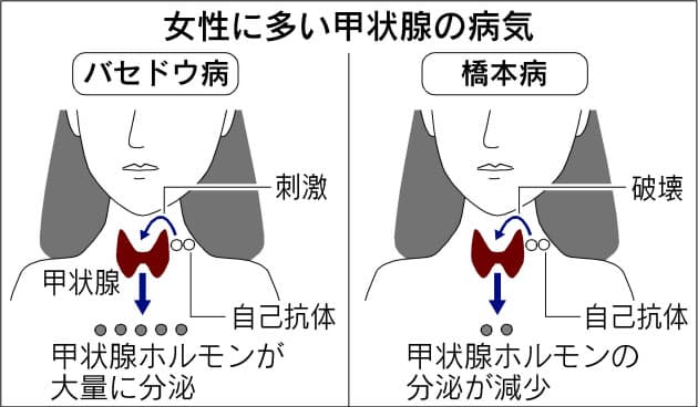 甲状腺 病気