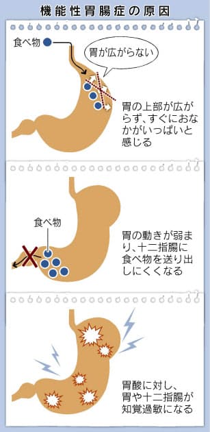 その胃もたれ 胃の痛み 機能性胃腸症の疑いも ストレス 早食いなど悪影響 Nikkei Style