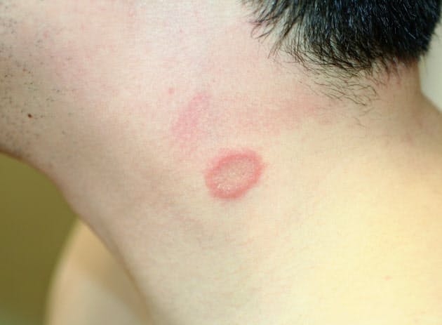 赤い 斑点 痒く ない 手の甲に赤い斑点ができる原因 症状 かゆみの有無で治療が違う