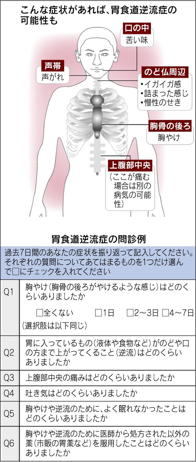 そのせき のどの違和感 胃食道逆流症の可能性も Nikkei Style