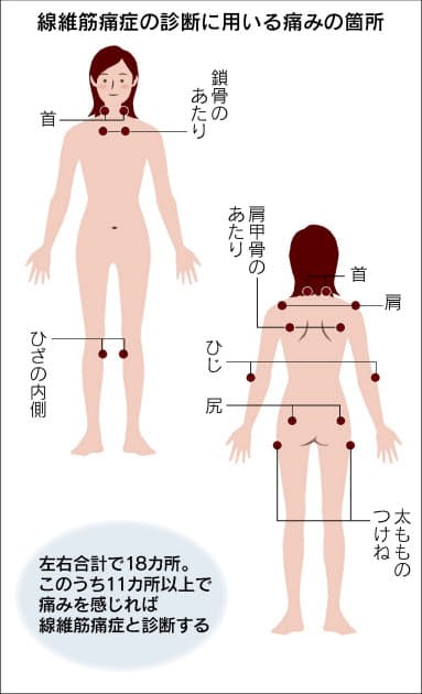 全身に激痛 女性に多い 線維筋痛症 早期診断が重要 Nikkei Style