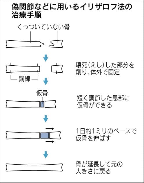 治りにくい骨折 偽関節 進む治療法 仮骨育成や自家骨移植 幹細胞使う再生も研究 Nikkei Style 治りにくい骨折 偽関節 進む治療法 仮骨育成や自家骨移植 幹細胞使う再生も研究 Nikkei Style
