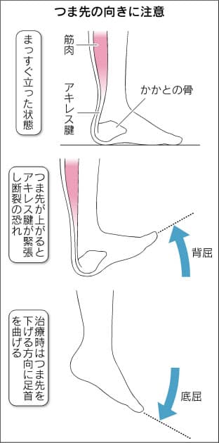 アキレス腱断裂 30 40代で多発 日常生活でも発生 Nikkei Style