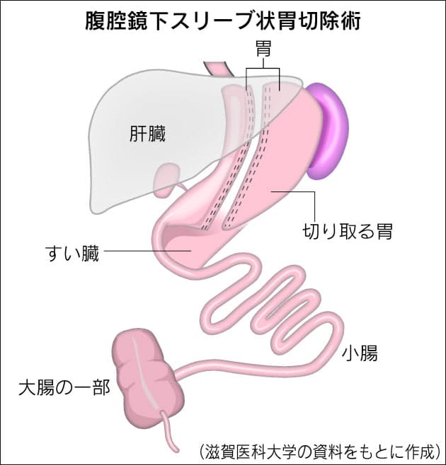 重度の肥満 胃を小さくする手術も選択肢 Nikkei Style 重度の肥満 胃を小さくする手術も選択肢 Nikkei Style