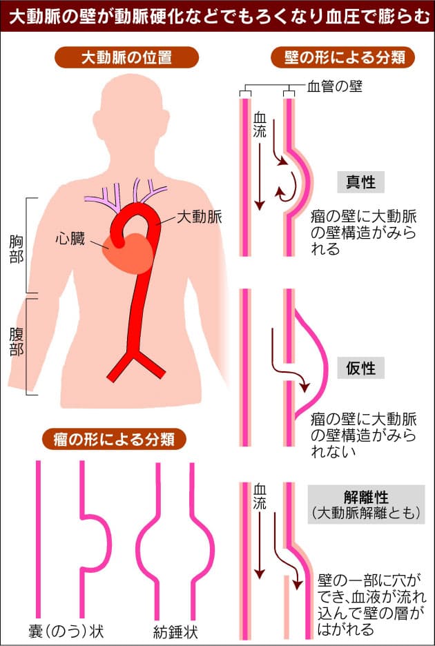 瘤 仮性 動脈