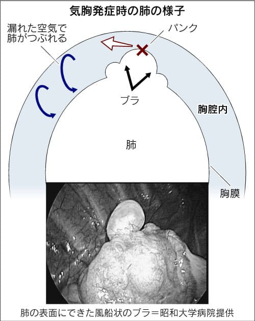 気胸 症状 肺