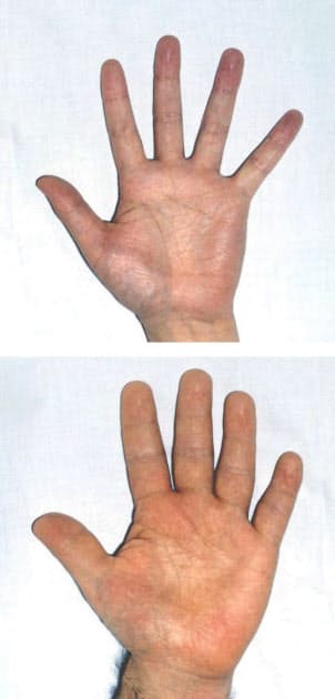 先端巨大症 成人後に過剰分泌 合併症招く 顔つき変貌 手足が肥大 ひどい いびき Nikkei Style