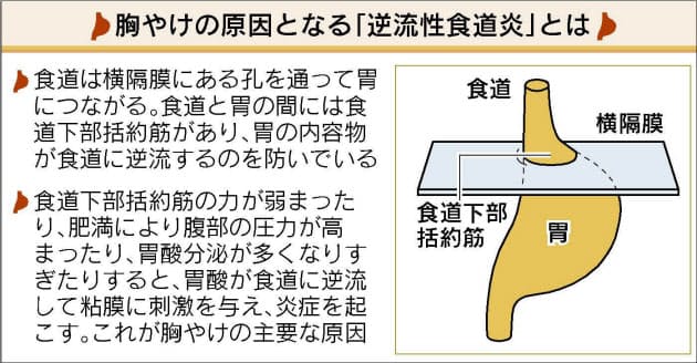 食道 炎 ストレス 逆流 性