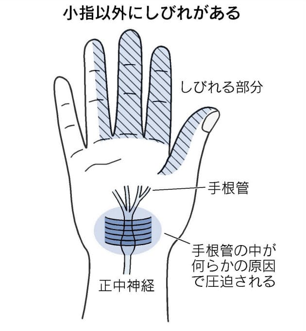 指のしびれ 手根管症候群 かも 老化と勘違い Nikkei Style
