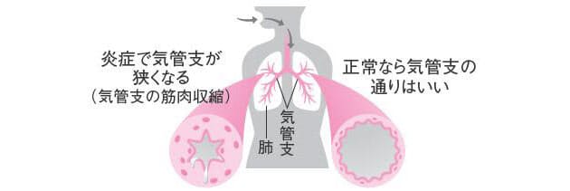 その息苦しさは 病気かも 女性に多い 気管支ぜん息 Nikkei Style その息苦しさは 病気かも 女性に多い 気管支ぜん息 Nikkei Style