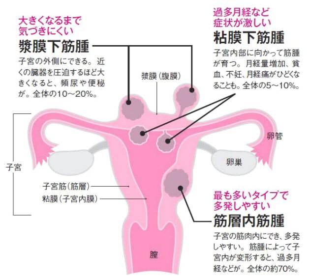 ぽっこりお腹 は婦人科系の病気を疑って Nikkei Style