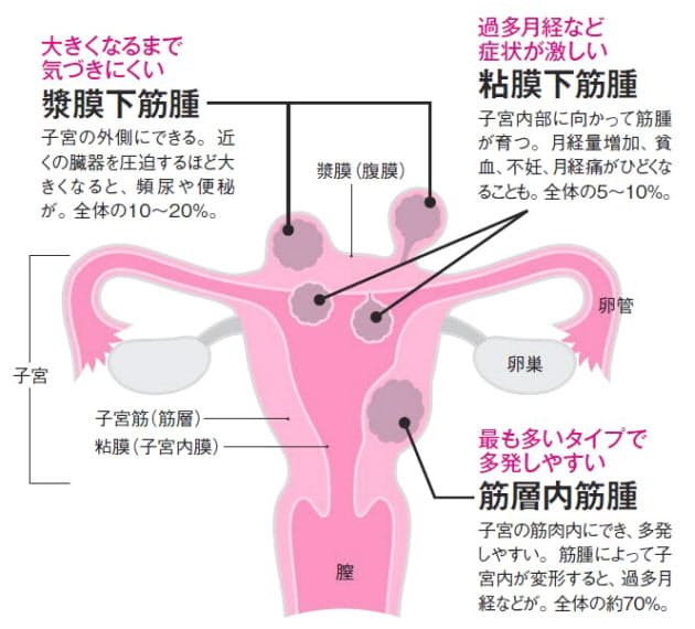 子宮 筋腫 お腹 ぽっこり 画像