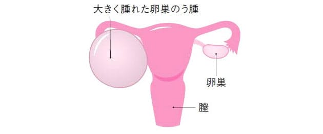 卵巣 嚢腫 髪の毛