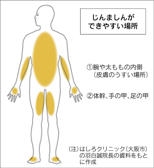 画像 ストレス湿疹 ストレス性皮膚炎の症状と対処法【市販薬のおすすめは？】