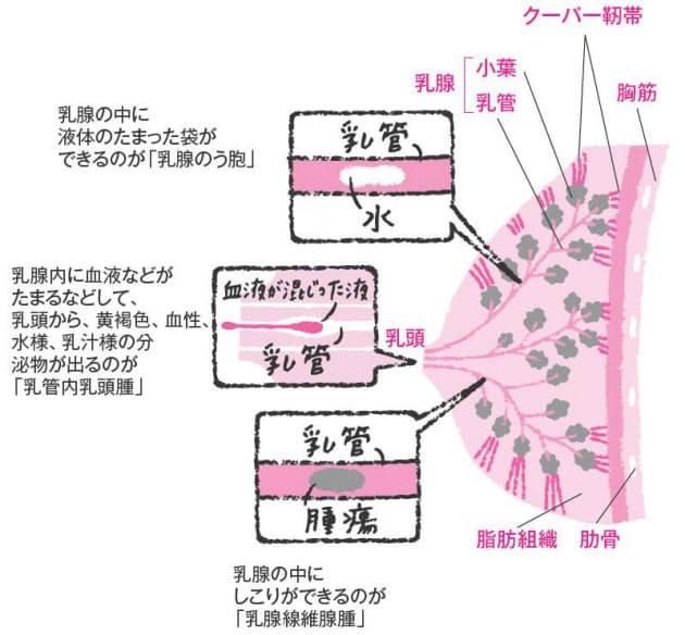 乳腺 線維 腺腫