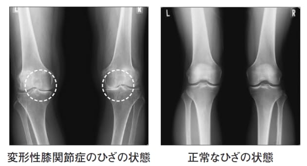 変形性膝関節症の最大原因は肥満と運動不足 歩幅が狭くなったら注意 つらい ひざ Nikkei Style 変形性膝関節症の最大原因は肥満と運動不足 歩幅が狭くなったら注意 つらい ひざ Nikkei Style