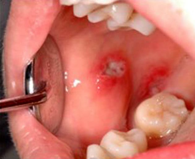 の 口内炎 原因 裏 舌 唇に口内炎が出来る原因は？３つの治し方を知っておこう！