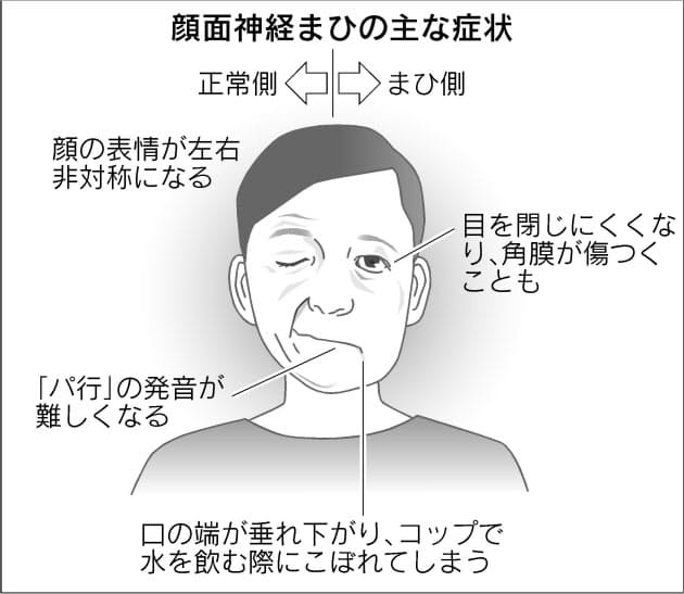 片頬にゆがみなら 顔面神経まひ 放置で後遺症も Nikkei Style