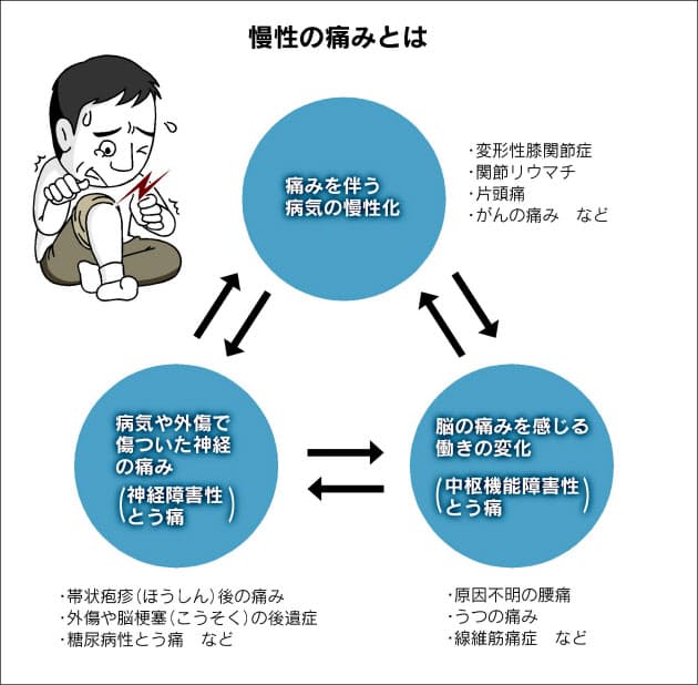 なぜか続く痛み 慢性痛 治療に新たなアプローチ Nikkei Style