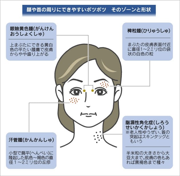 どう対処 顔や首のポツポツ 自己処置は危険 Nikkei Style