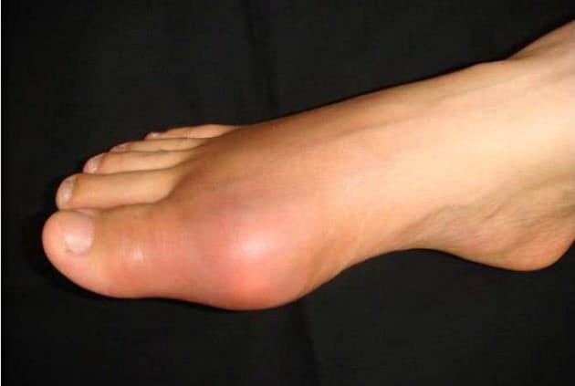 足の親指の腫れ 足の指が腫れる原因一覧！症状別に９つのポイントをチェックしよう