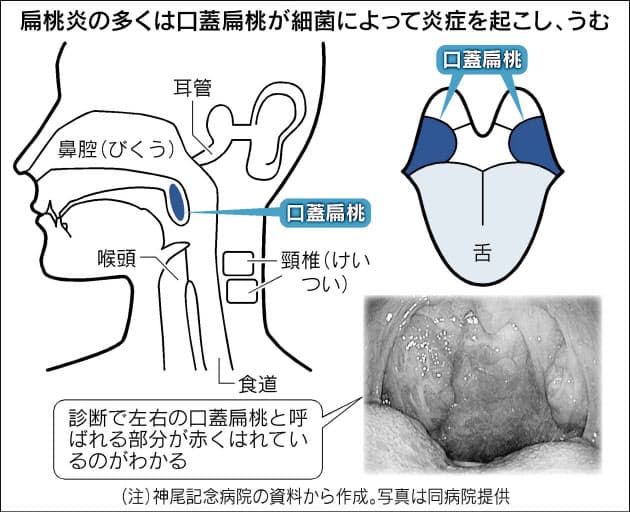 熱 のどの痛み 扁桃炎 風邪と勘違いに注意を Nikkei Style