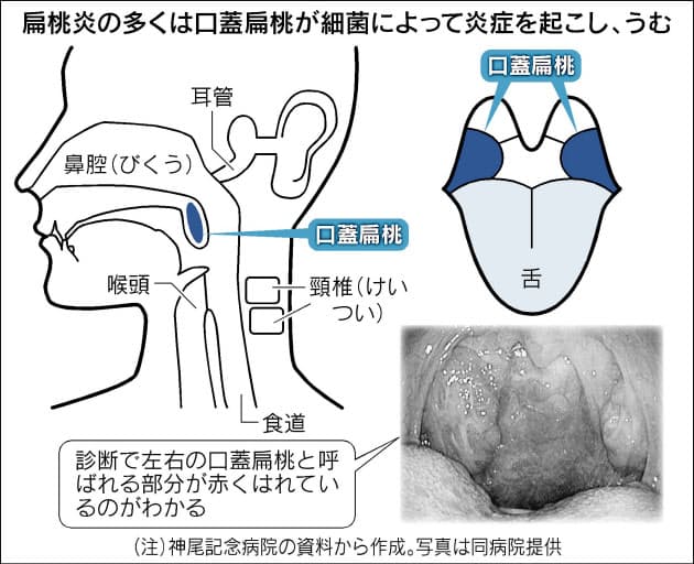 扁桃 炎 繰り返す