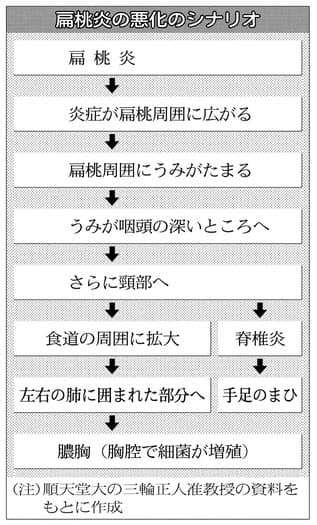 熱 のどの痛み 扁桃炎 風邪と勘違いに注意を Nikkei Style 熱 のどの痛み 扁桃炎 風邪と勘違いに注意を Nikkei Style