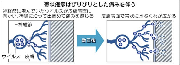 帯状疱疹 若い世代も発症 早めの治療で後遺症防ぐ Nikkei Style 帯状疱疹 若い世代も発症 早めの治療で後遺症防ぐ Nikkei Style