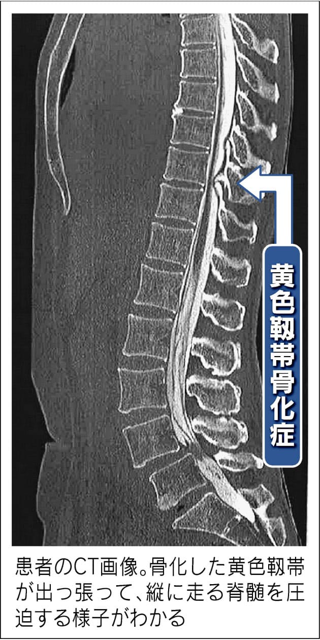 後 縦 靭帯 骨 化 症 有名人