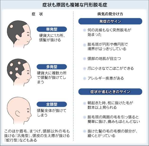 円形脱毛症 治療は根気よく 注射と服薬組み合わせ ヘルスｕｐ Nikkei Style