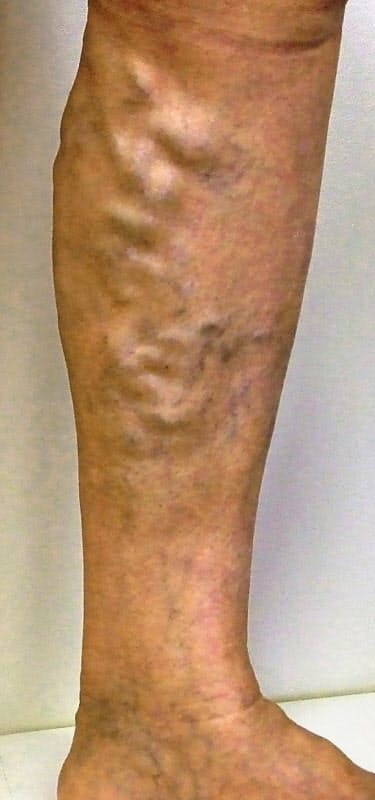 足の静脈瘤の治療 レーザー 高周波で負担減 Nikkei Style