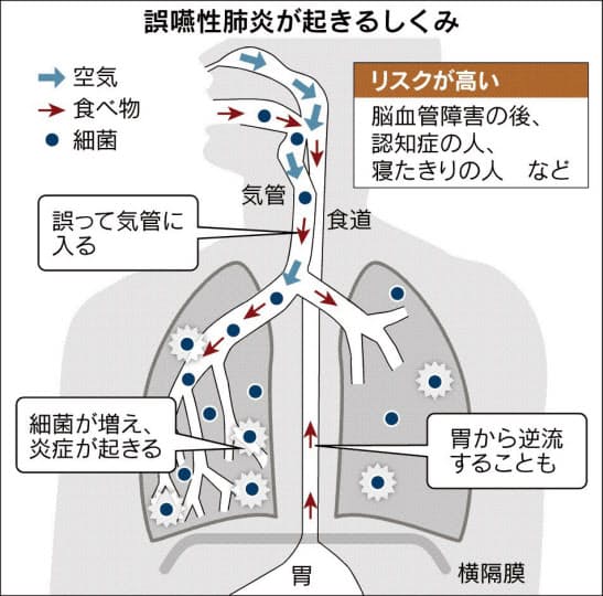 高齢者に多い肺炎 誤嚥性 は歯磨きで予防を Nikkei Style