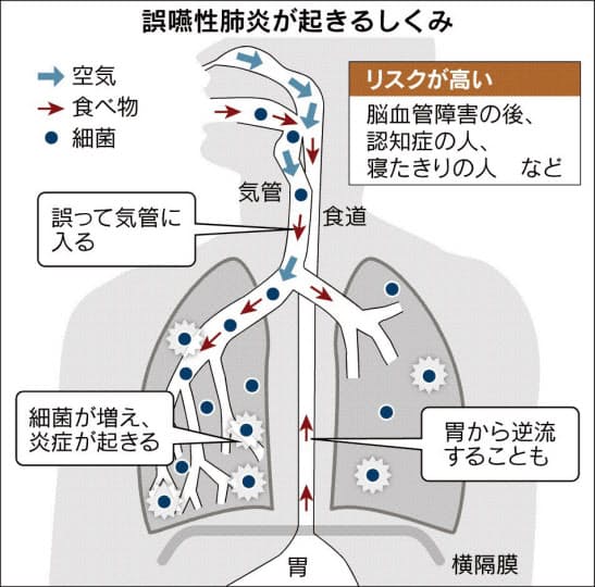高齢者に多い肺炎 誤嚥性 は歯磨きで予防を Nikkei Style 高齢者に多い肺炎 誤嚥性 は歯磨きで予防を Nikkei Style