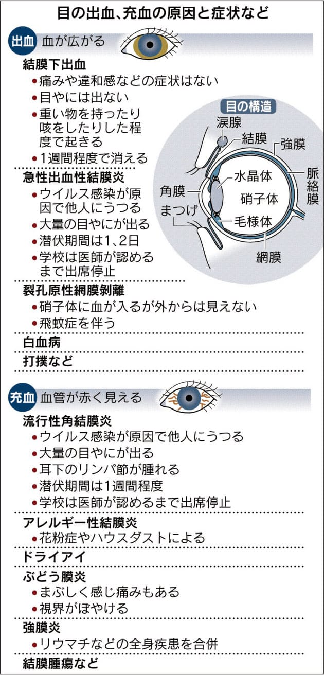 目が真っ赤 結膜下出血 充血に気をつけよう Nikkei Style