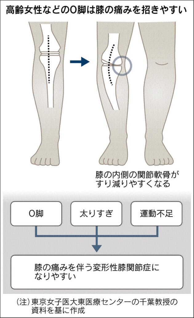 大人のo脚 膝痛注意 変形性膝関節症かも Nikkei Style