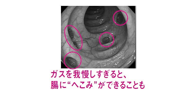 ガス が 溜まっ て お腹 が 痛い