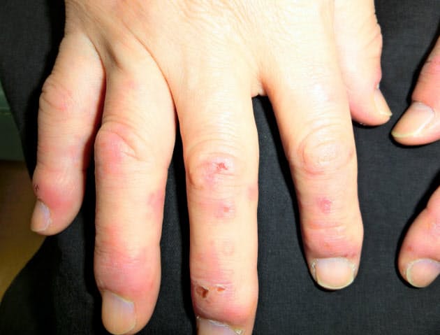 て 指 が の 血管 痛い 腫れ 血管が浮き出る原因は何故？４つの部位別の主な症状と対処法