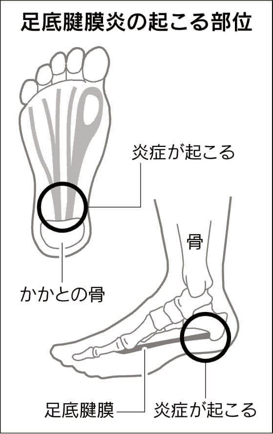 足の裏に痛み 足底腱膜炎 足休めて衝撃波で治療も ヘルスｕｐ Nikkei Style