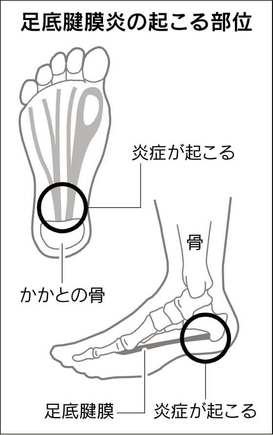 足の裏に痛み 足底腱膜炎 足休めて衝撃波で治療も ヘルスｕｐ