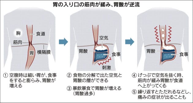 食道炎 長引く胸の違和感 痛み Nikkei Style