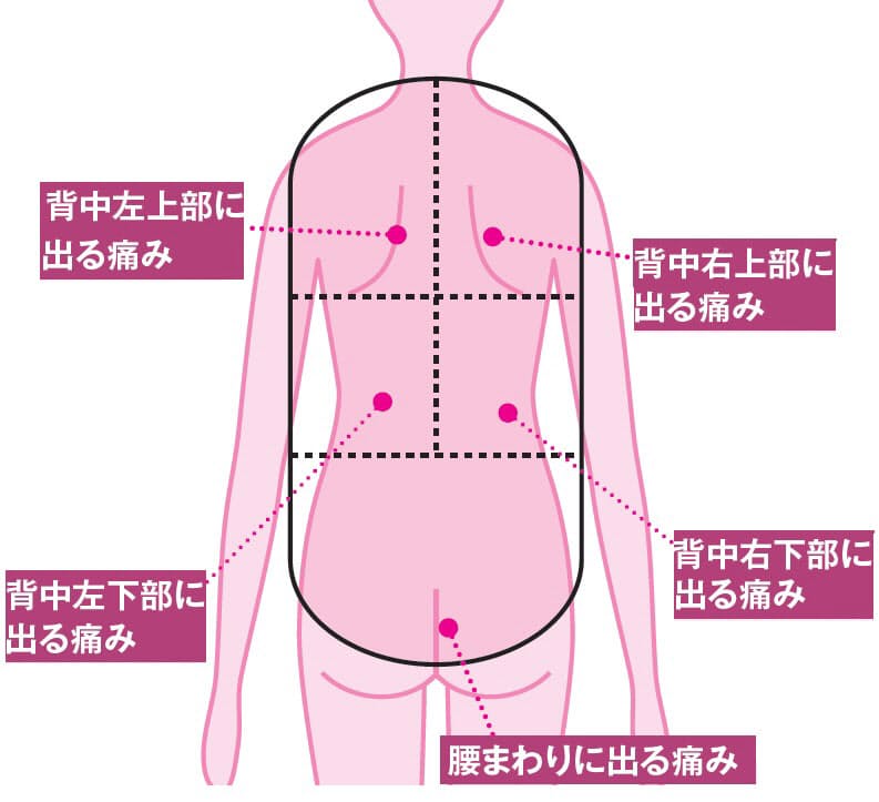 背中 張り 腰痛 の